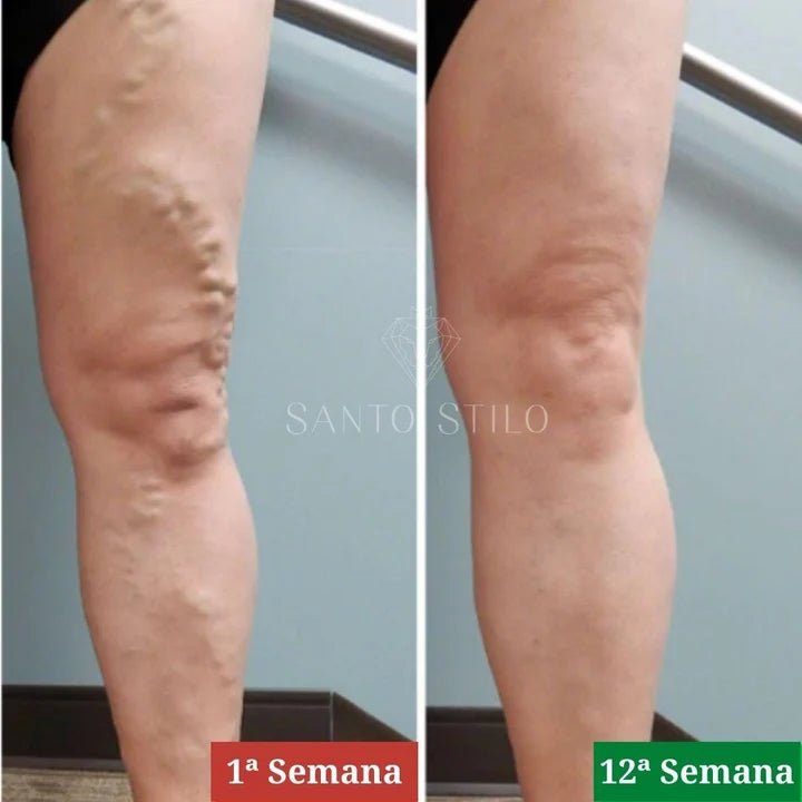 Parches Naturales para Varices y para las Piernas Cansadas - VeinPatch™ - Tienda Ravenza